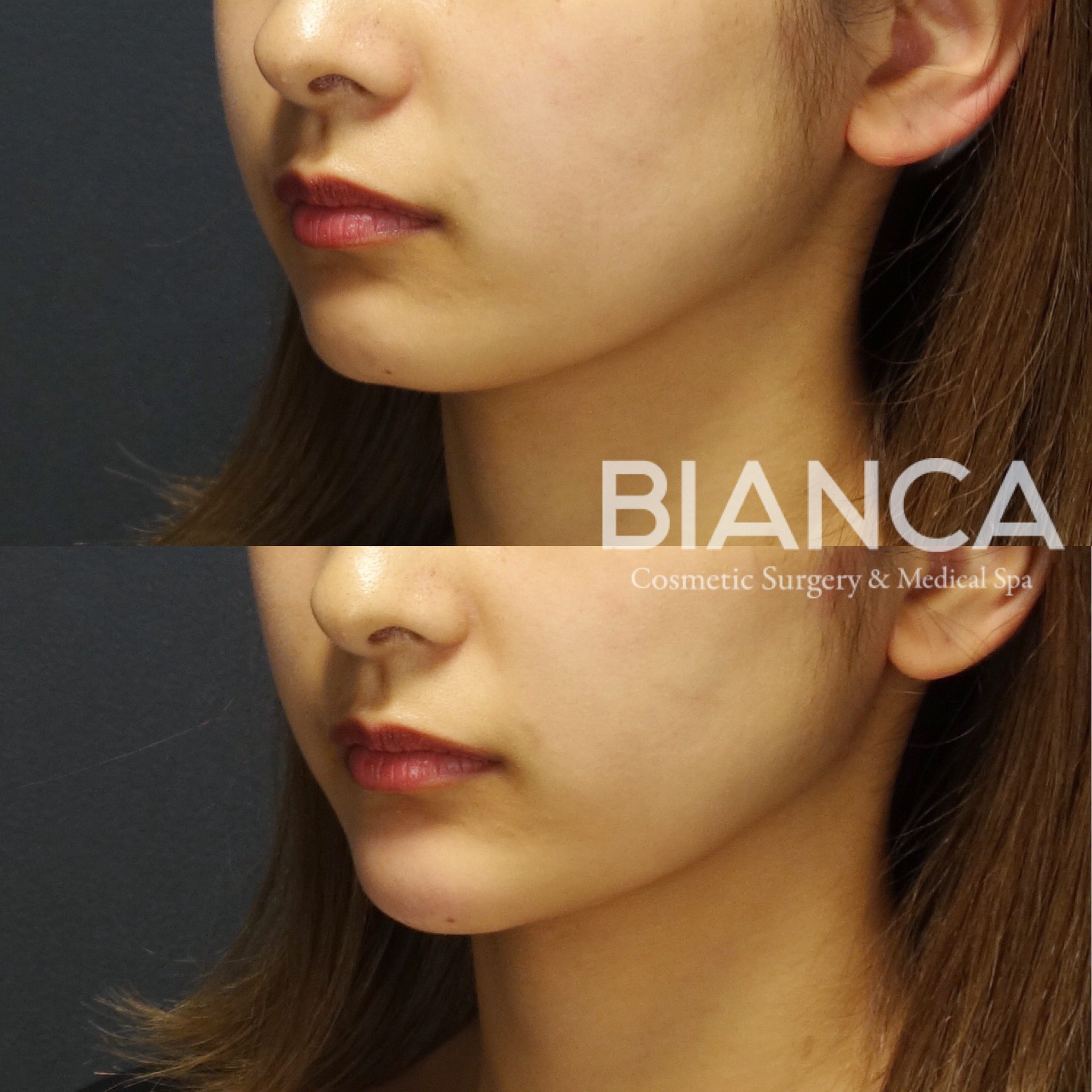 【小顔治療】顎ヒアル×顎ボトックスでフェイスラインはここまで変わる！