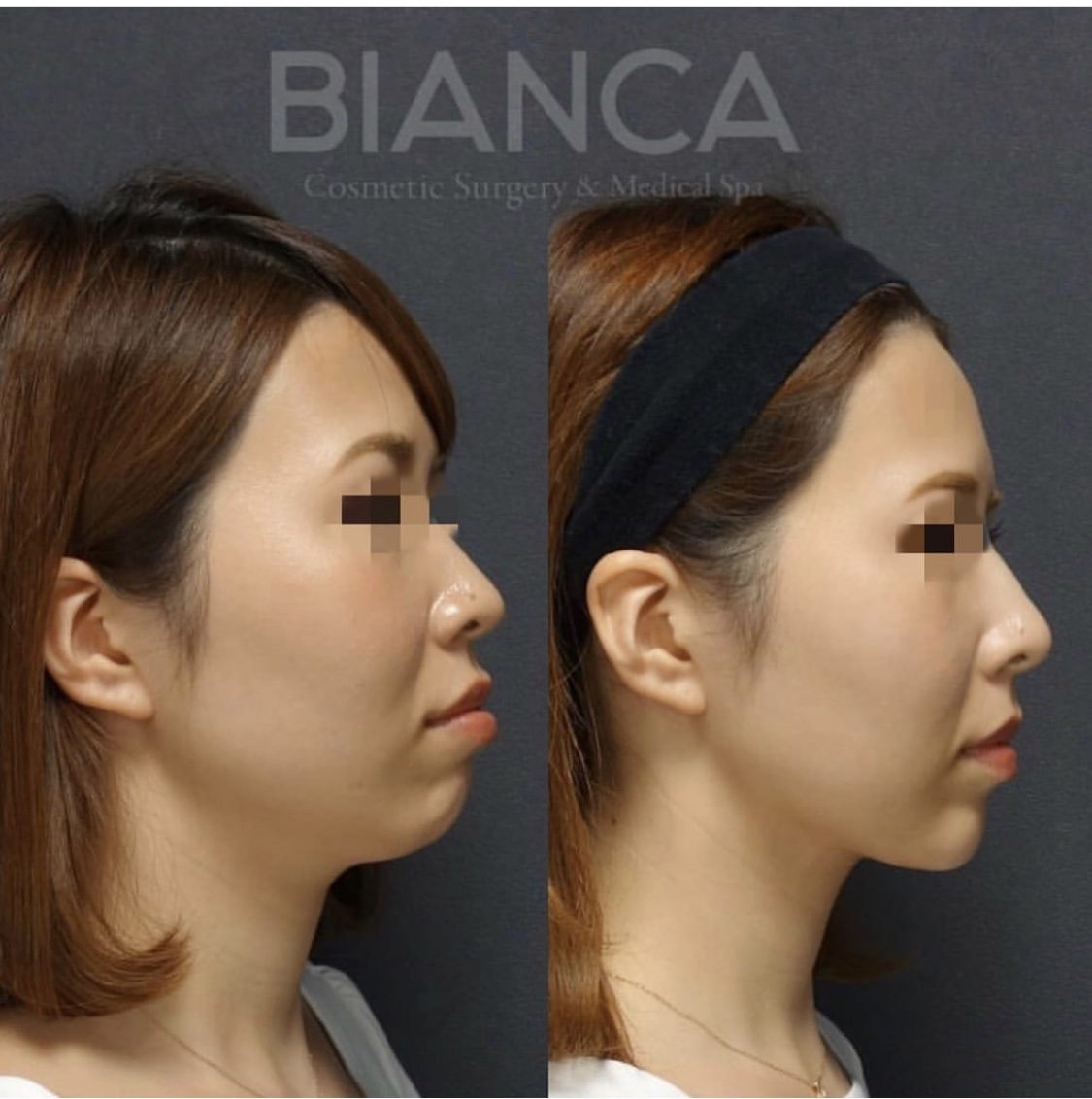 Eラインとは？ヒアルロン酸注射で横顔美人に