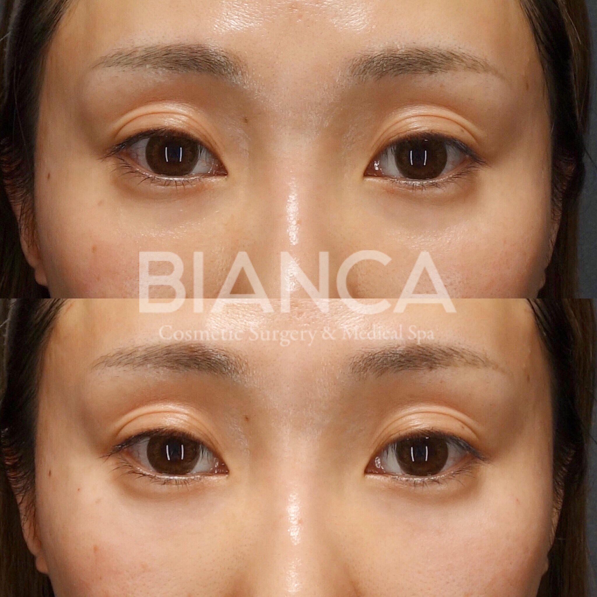 ベビーコラーゲンによる目の下の凹み・クマ・ちりめんジワなどの改善症例・ビフォーアフター