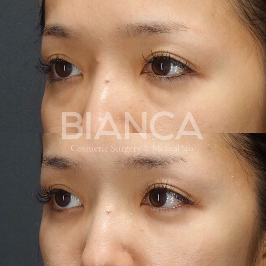 目の下クマ・たるみ取り（経結膜脱脂術）とコンデンスリッチフェイス（CRF）目の下によるクマ治療、症例写真・ビフォーアフター