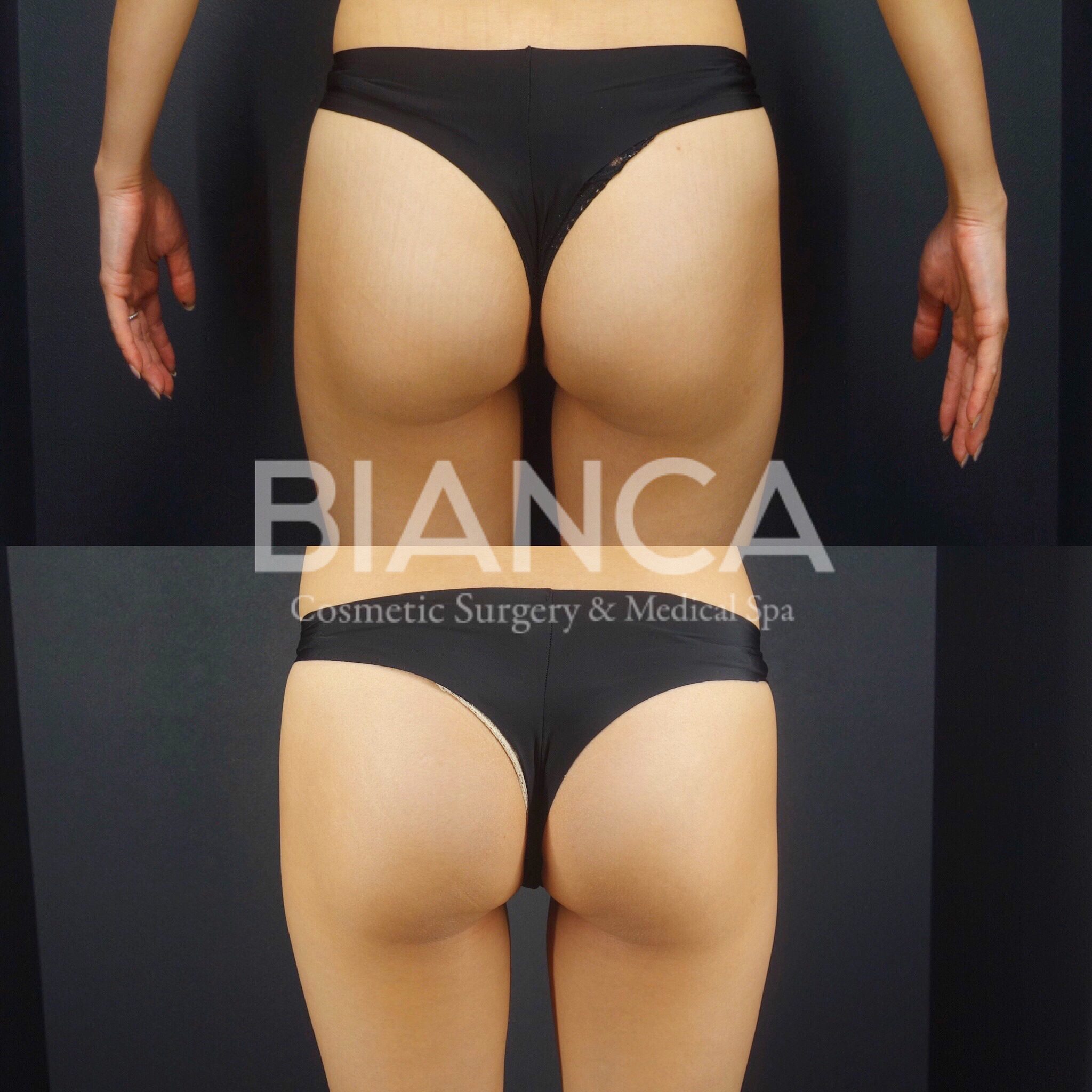 EMSCULPT®︎(エムスカルプト)によるメディカルボディメイク症例写真・ビフォーアフター