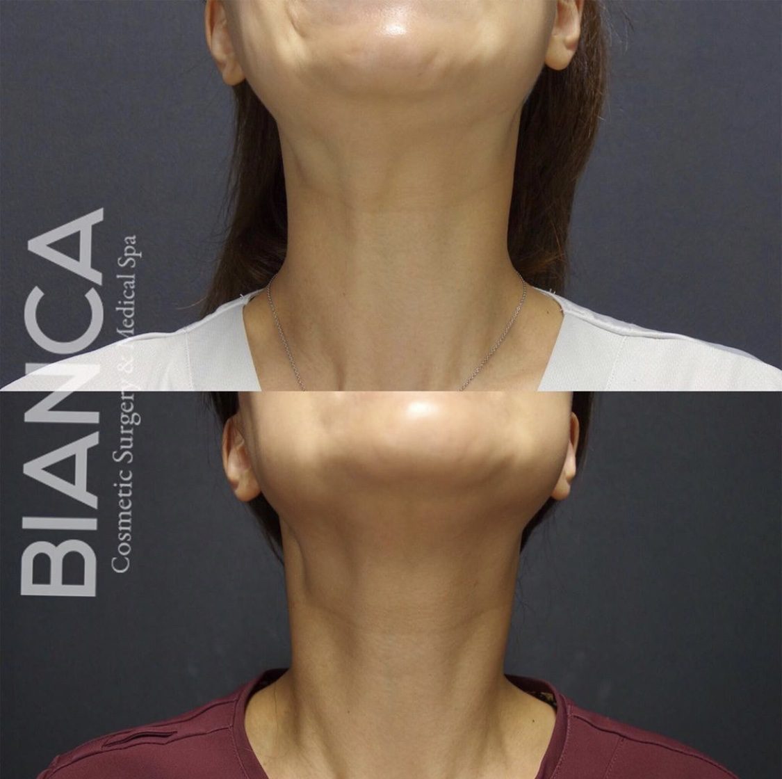 首ボトックス(ネックボトックス)の症例写真・ビフォーアフター