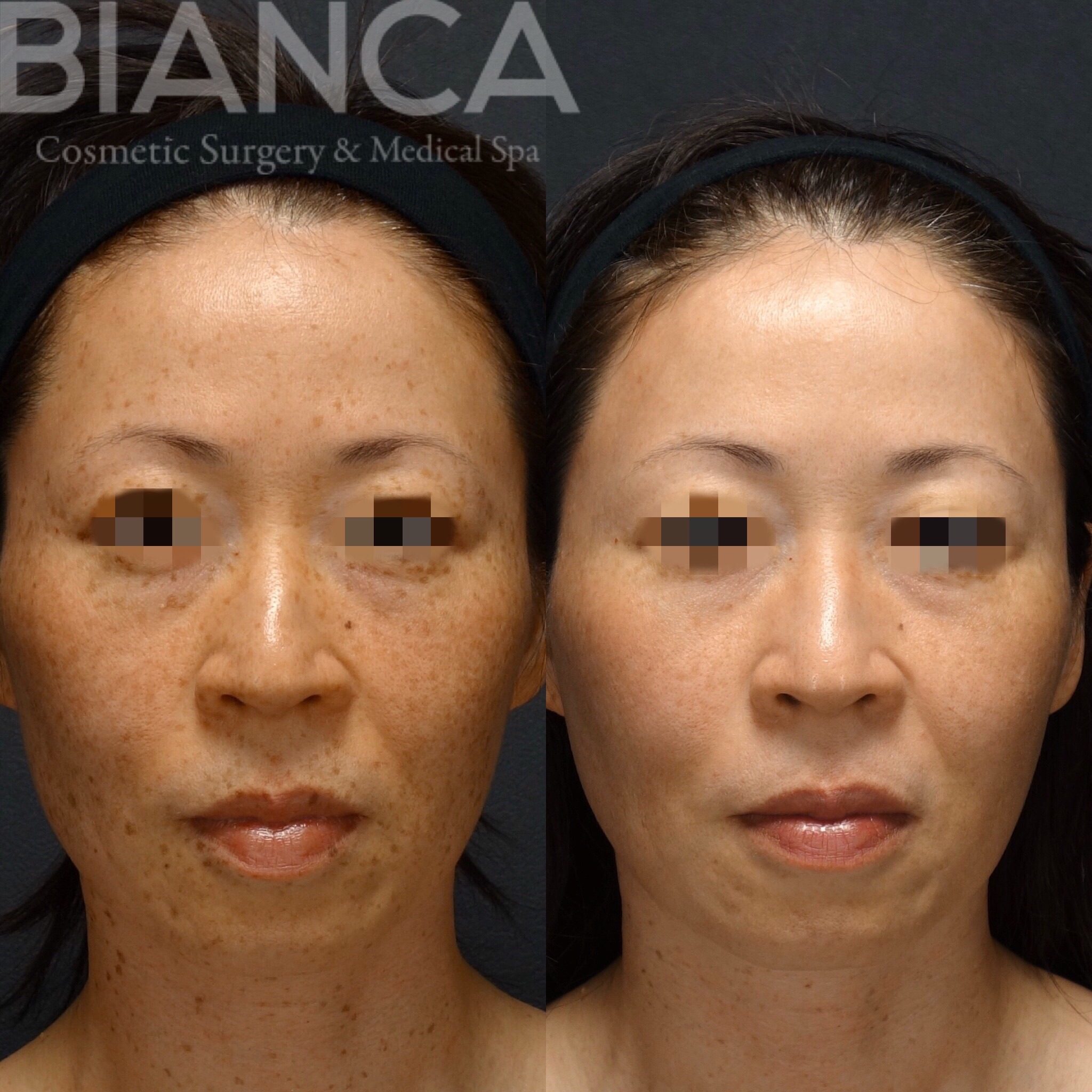 ピコスポット＋ピコトーニング