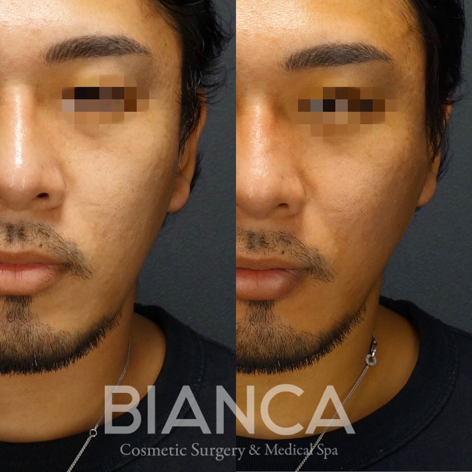 男性のフェイスラインを引き締めるには？たるみの原因と改善アプローチを医師が解説【ビアンカクリニック】