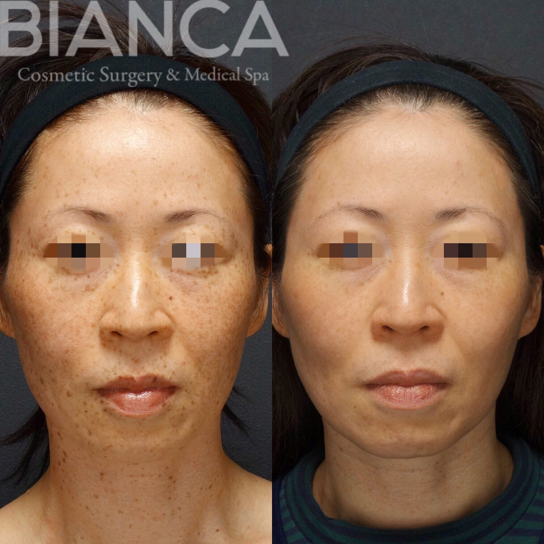 ピコシュア（PICO SPOT＋ピコトーニング）によるシミ治療の症例写真