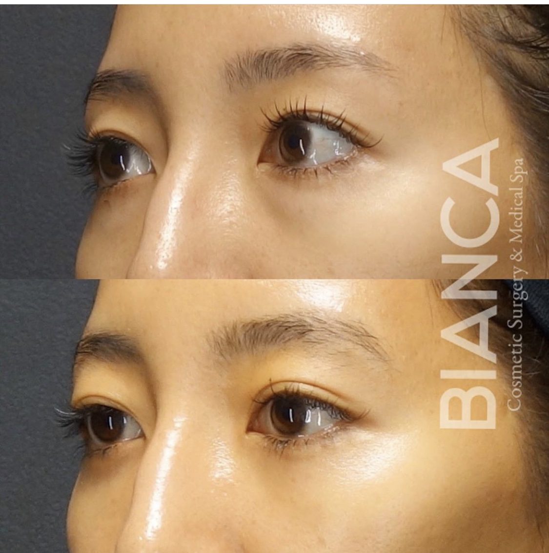 目の下クマ・たるみ取り（経結膜脱脂術）で目元がスッキリした症例写真・ビフォーアフター クマ取り（経結膜脱脂術）の経過は？腫れ・内出血・仕上がりを医師が解説【ビアンカクリニック】