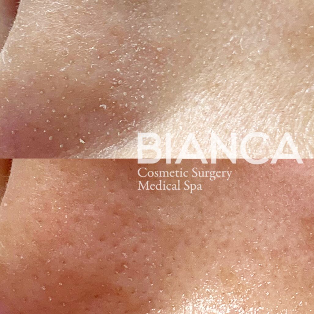 ハイドラフェイシャル（Hydrafacial）