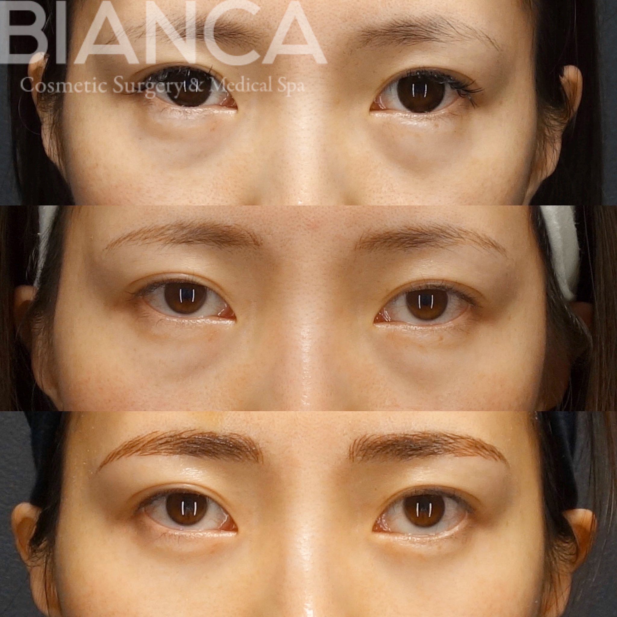 目の下クマたるみ取り✖️ヒアルロニダーゼ