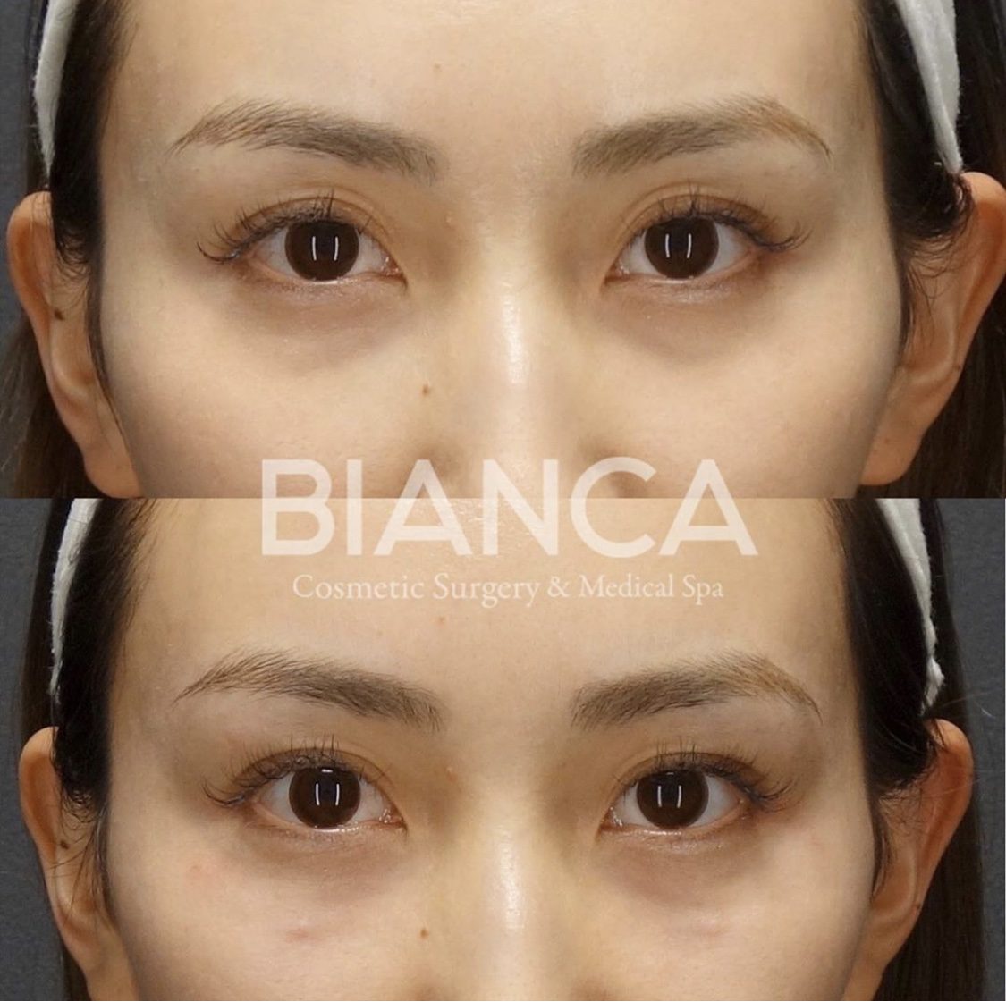 ヒアルロン酸（目周り）