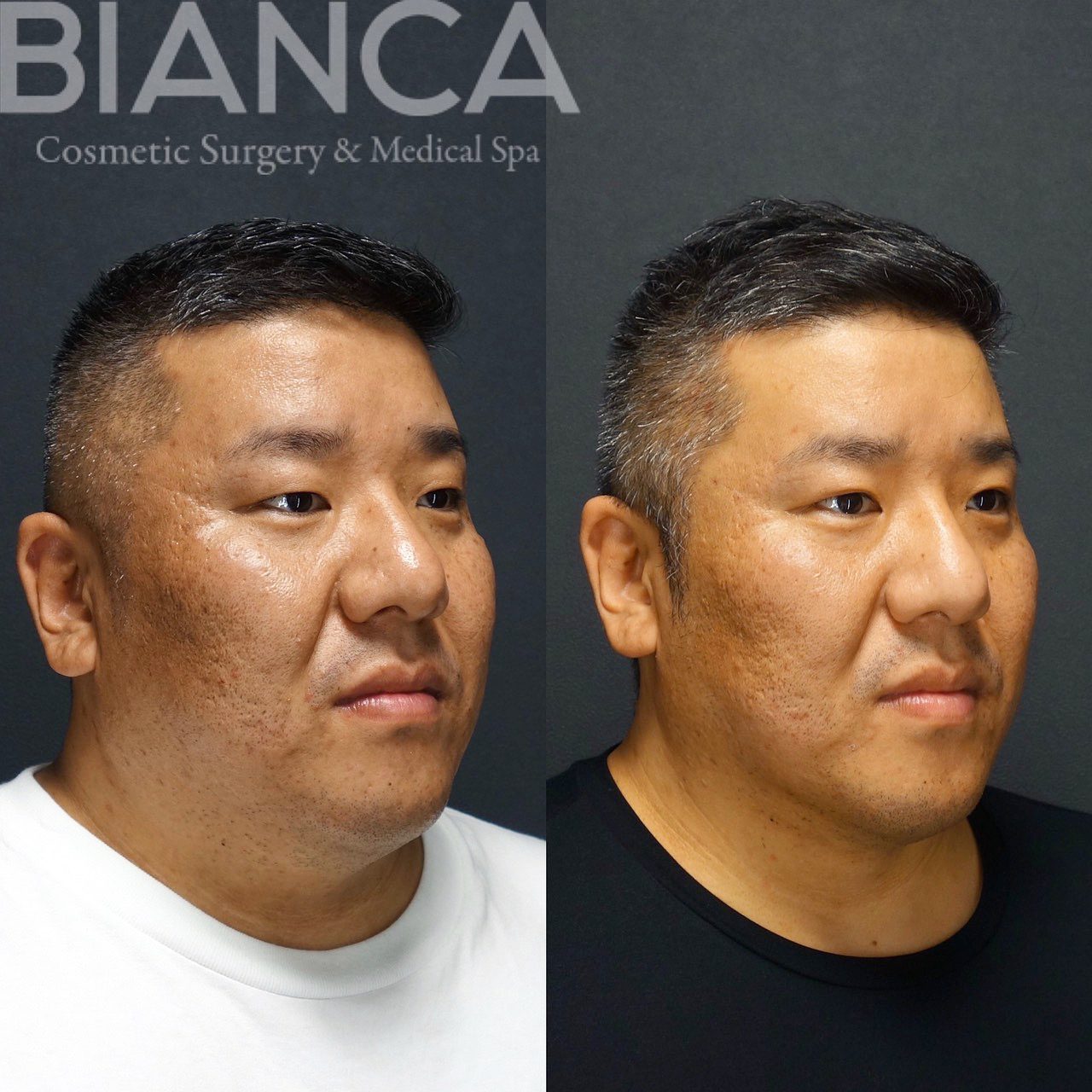 顎下脂肪吸引の症例写真・ビフォーアフター（男性）男性のフェイスラインを引き締めるには？たるみの原因と改善アプローチを医師が解説【ビアンカクリニック】