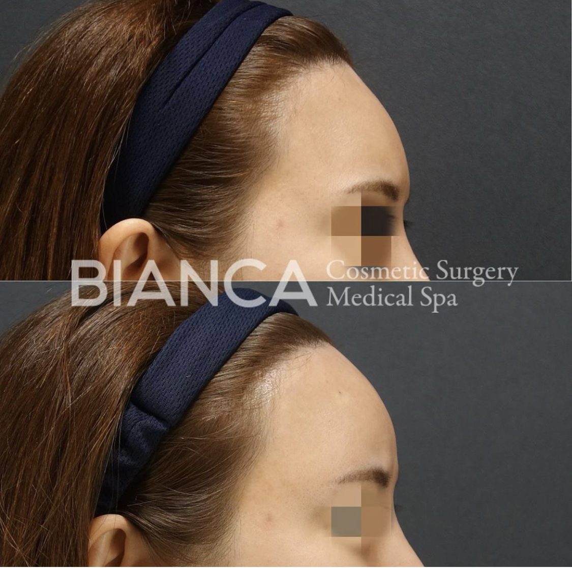 コンデンスリッチフェイスの症例写真・ビフォーアフター