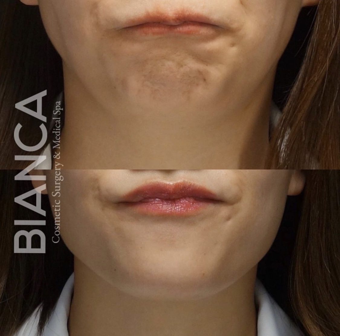 ボトックスで表情が不自然になる?後悔しないポイントを医師が解説【BIANCA CLINIC】‐顎ボトックスの症例写真・ビフォーアフター