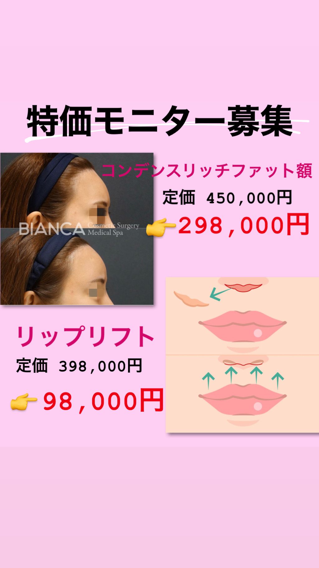 リップリフト （人中短縮）🉐モニター様募集します‼️