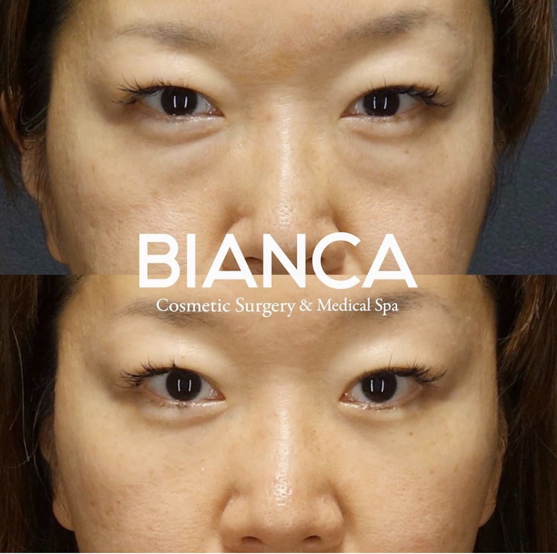 目の下クマ・たるみ取り（経結膜脱脂術）で目元がスッキリした症例写真・ビフォーアフター クマ取り（経結膜脱脂術）の経過は？腫れ・内出血・仕上がりを医師が解説【ビアンカクリニック】