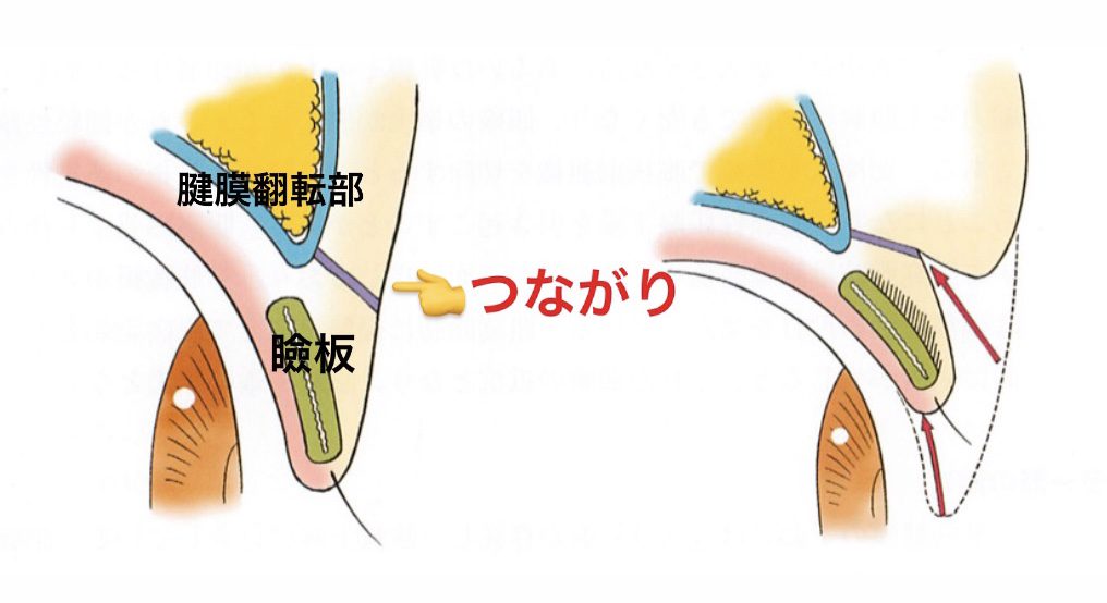 二重埋没法を比較！2点留め・4点留め・クロスリンク・BAメソッド・MT法でダウンタイムと持続力はどう違う？【医師監修】