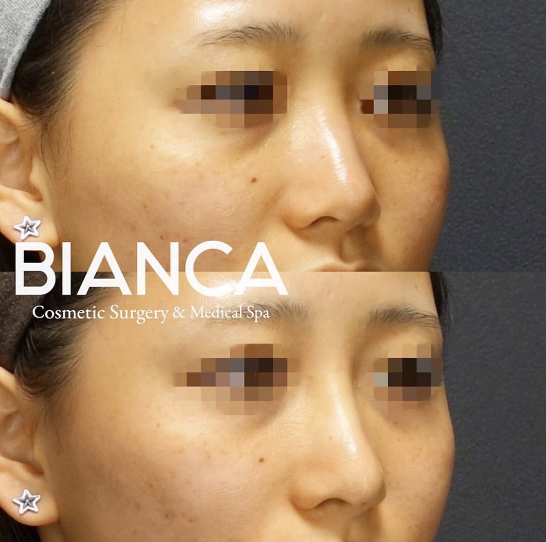 ヒアルロン酸（鼻先〜鼻筋）