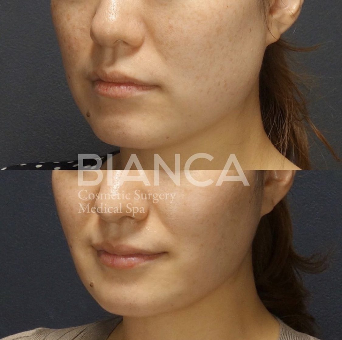 バッカルファット除去 ✖️スレッドリフト✖️フェイスライン脂肪吸引