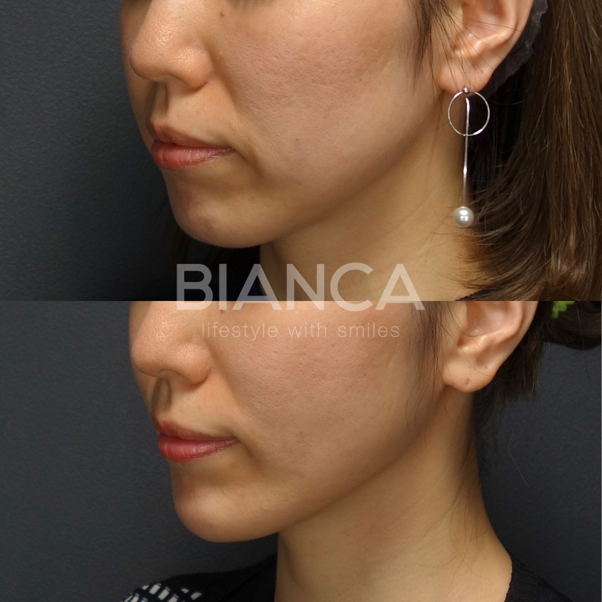 BIANCALIFT、ヒアルロン酸注射(顎)、ボトックス注射(顎)