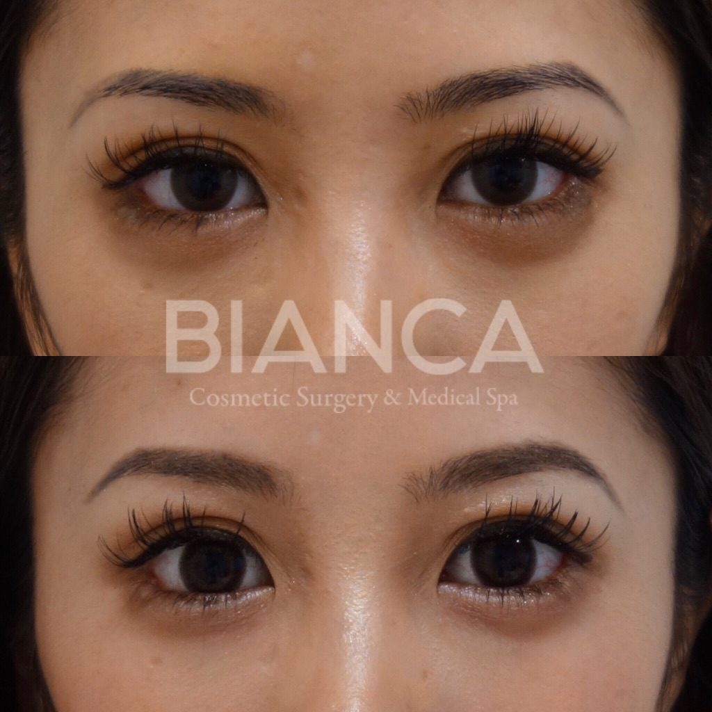 ヒアルロニダーゼ