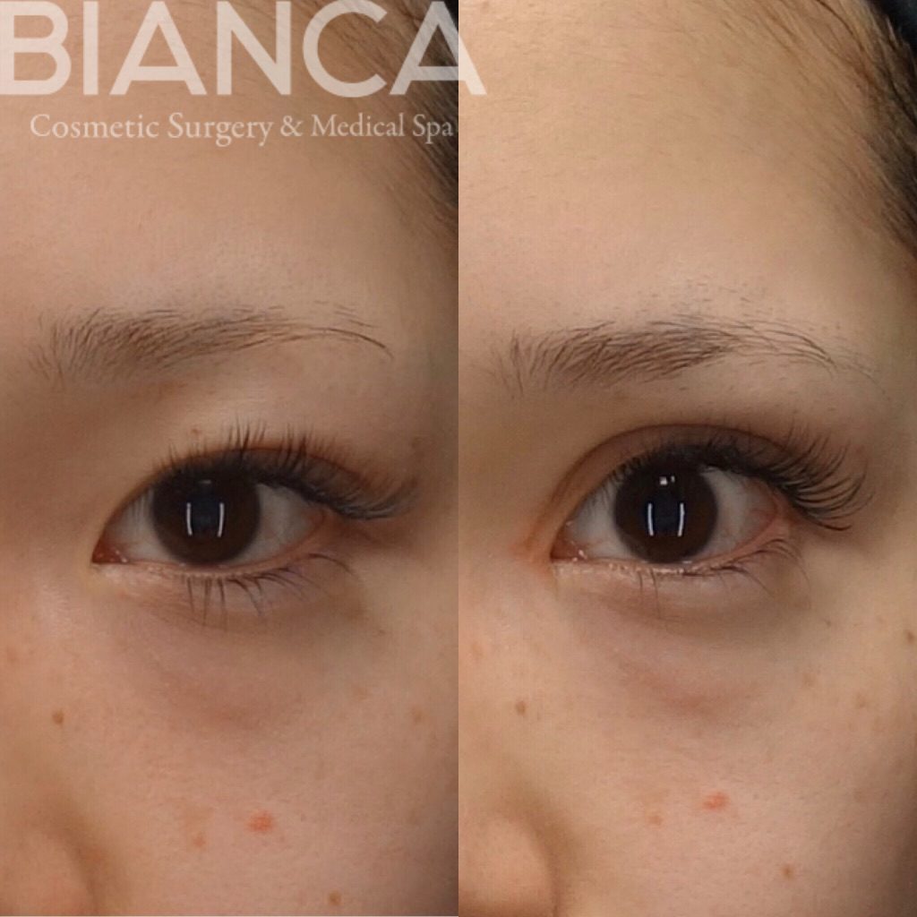 二重全切開✖️目頭切開