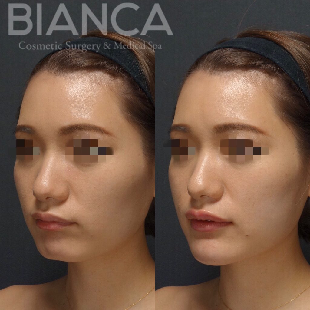 ヒアルロン酸（唇・頬）