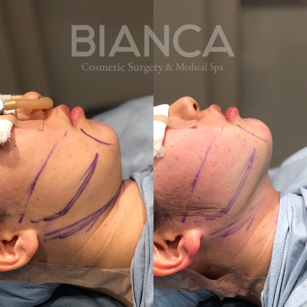 フェイスライン脂肪吸引