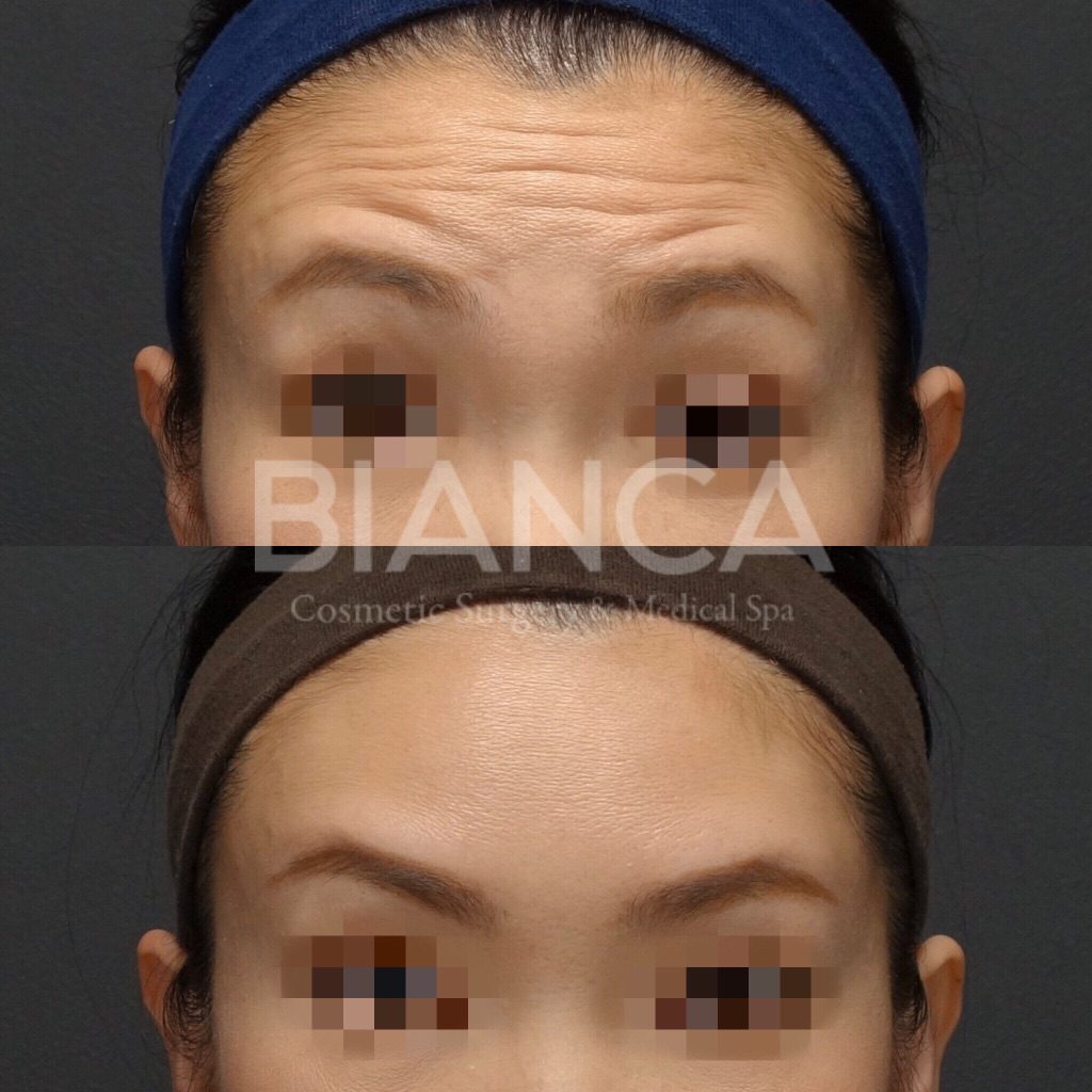 ボトックス注射（額）