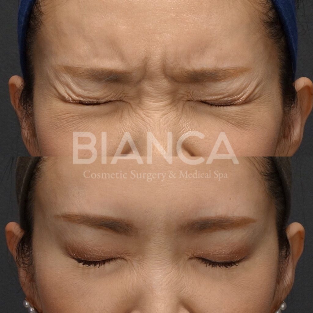 ボトックス注射（眉間）