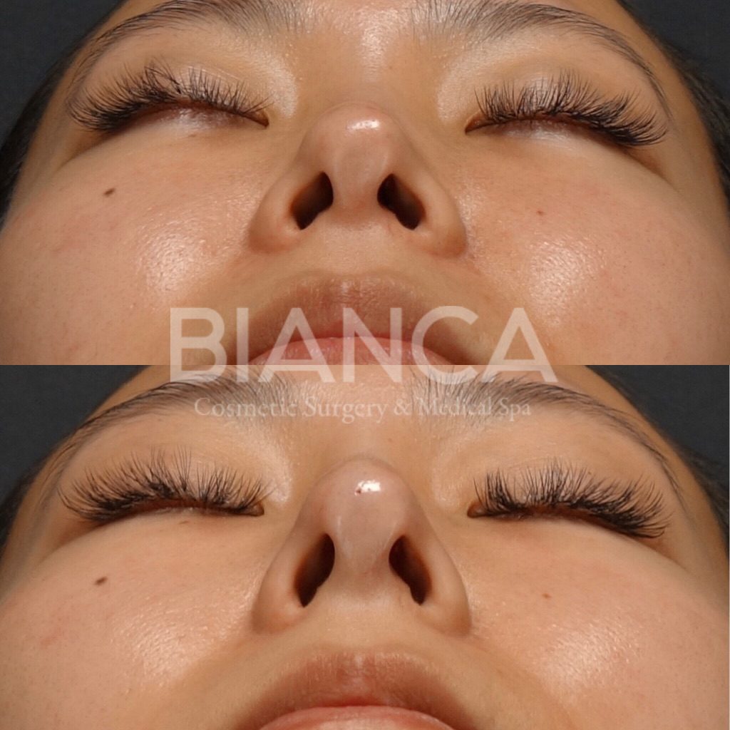 ヒアルロン酸（鼻先）