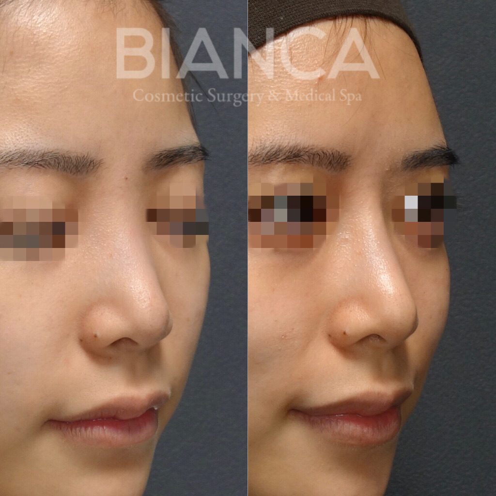 鼻プロテーゼ✖️鼻翼縮小