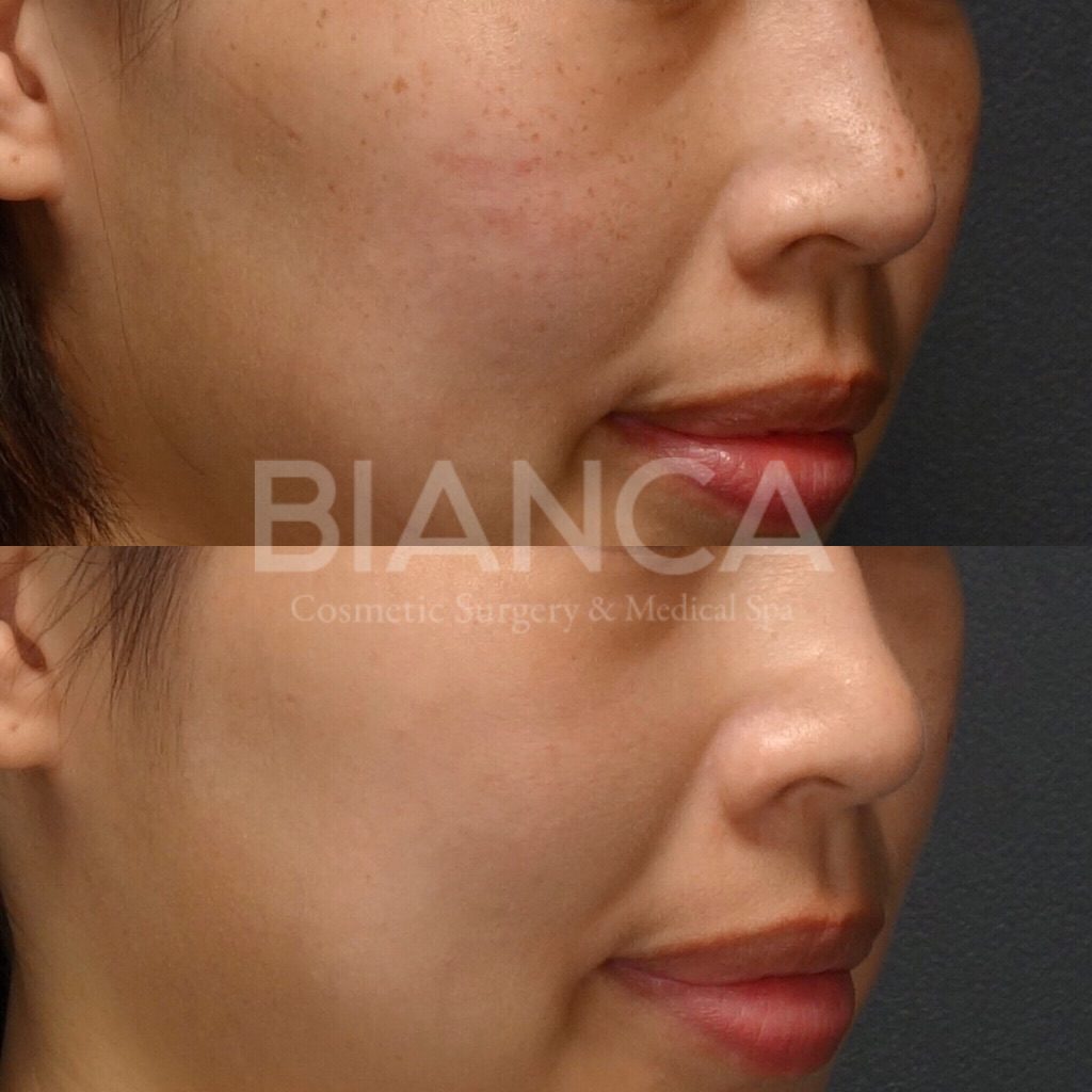 ピコシュアを用いたピコスポット、ピコトーニングによるシミ・そばかす治療の症例