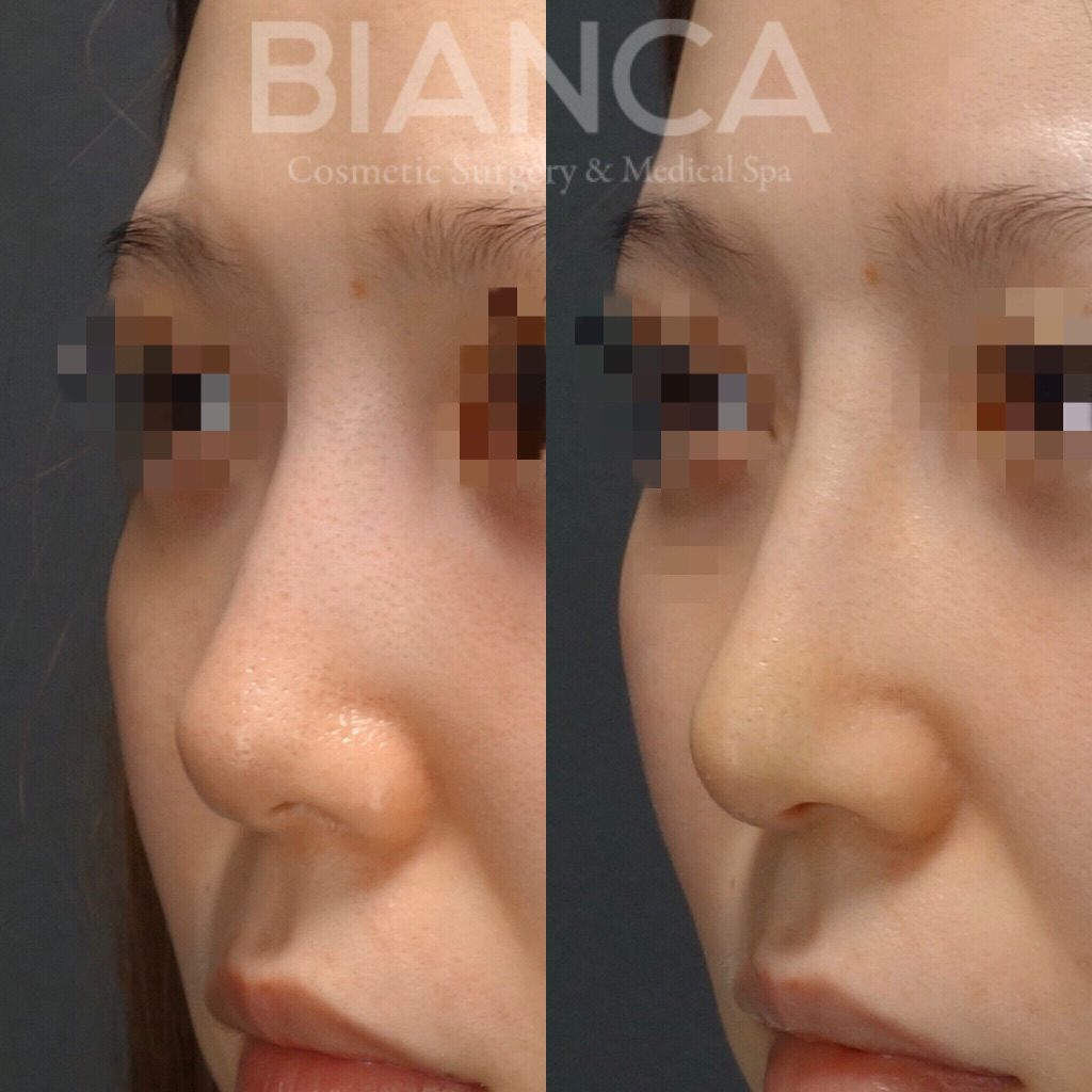 耳介軟骨移植✖️鼻尖縮小✖️鼻プロテーゼ