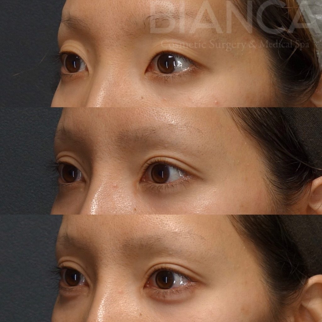 二重全切開＋目頭切開＋ヒアルロン酸