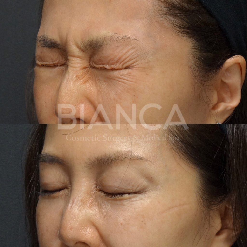 ボトックス注射（目尻）