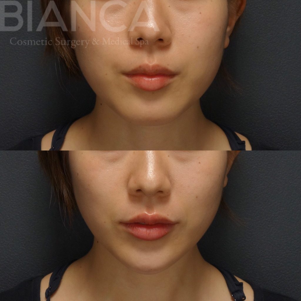 ヒアルロン酸注入