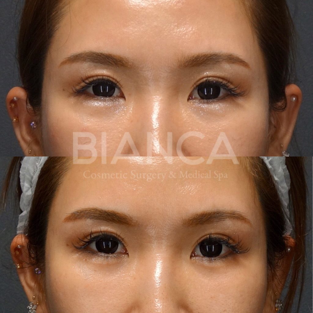 ヒアルロニダーゼ