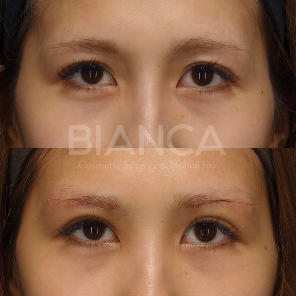 眉下切開 術後1週間