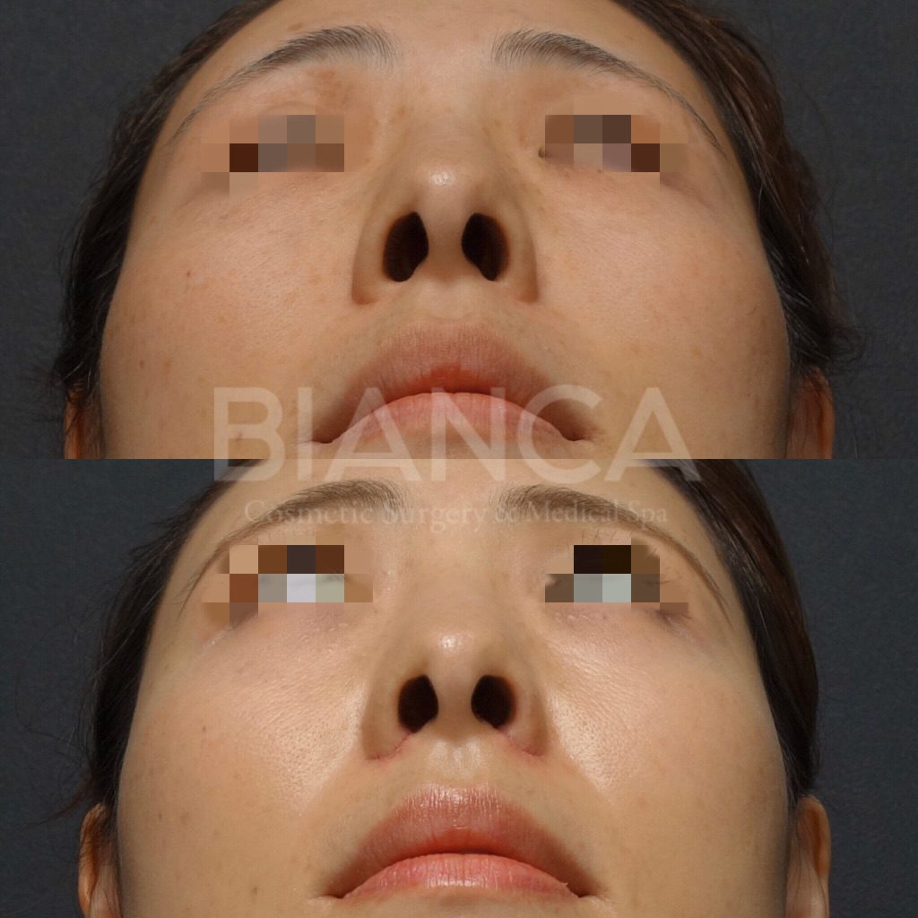 鼻翼縮小（抜糸直後）