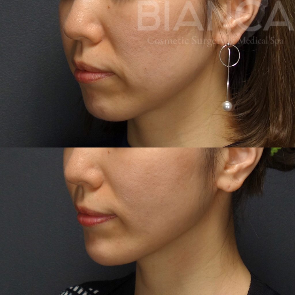 スレッドリフト＋ヒアルロン酸＋ボトックス