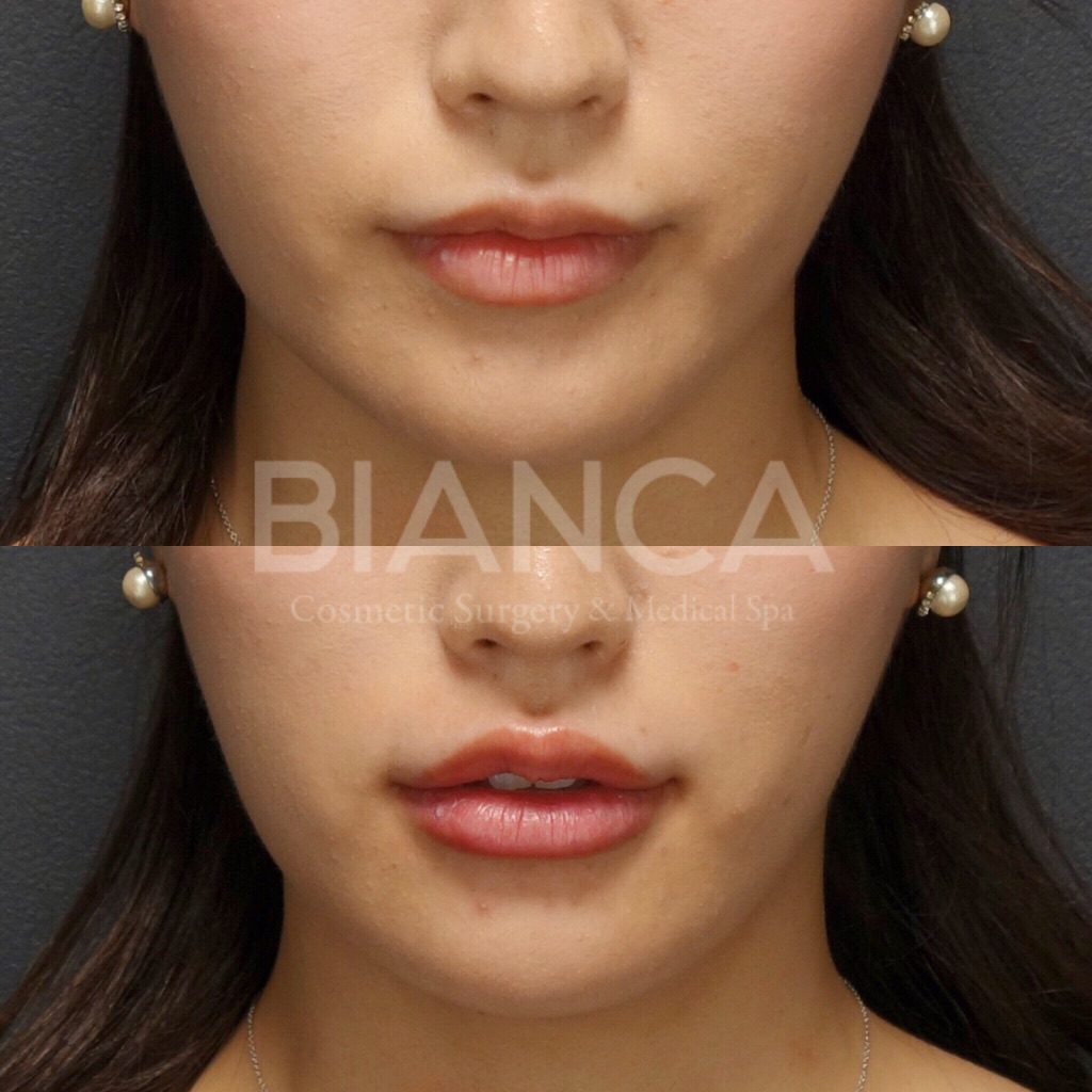 ヒアルロン酸注入