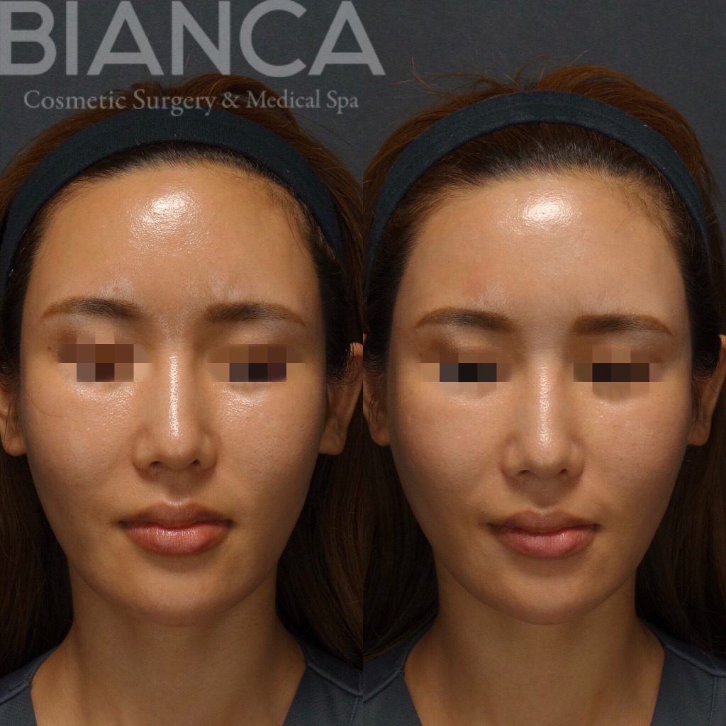 スレッドリフト