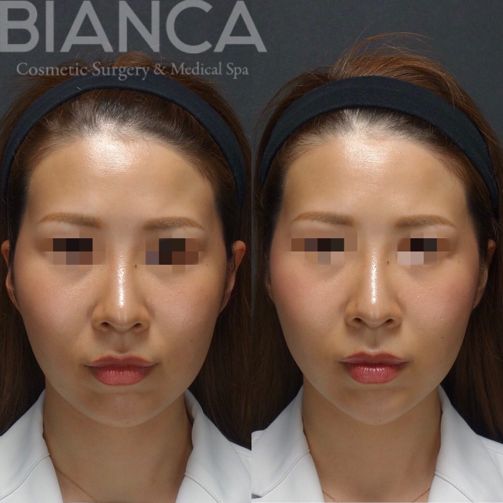 スレッドリフト