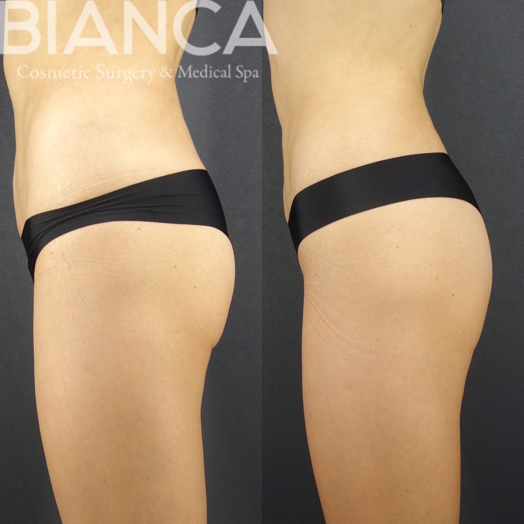 エムスカルプト（EMSCULPT）