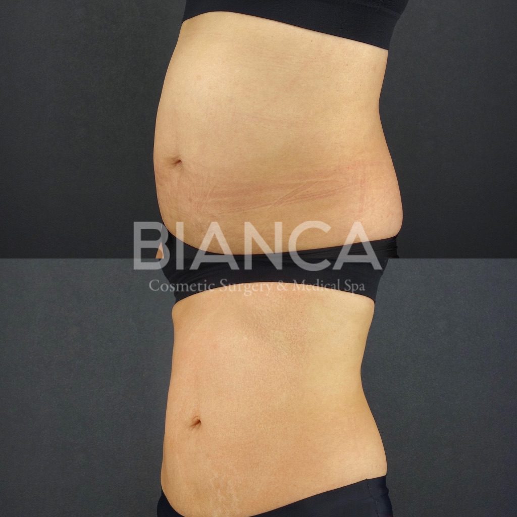 エムスカルプト（EMSCULPT）