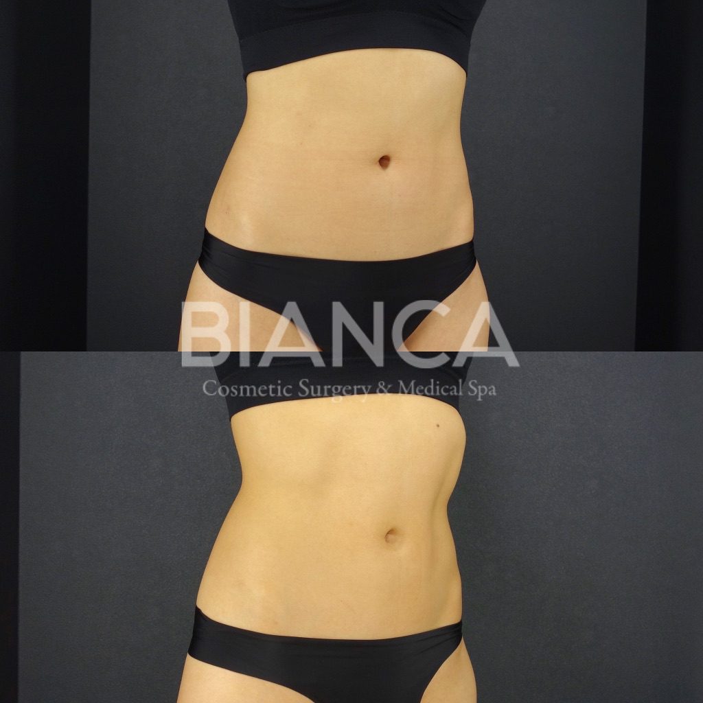 エムスカルプト（EMSCULPT）