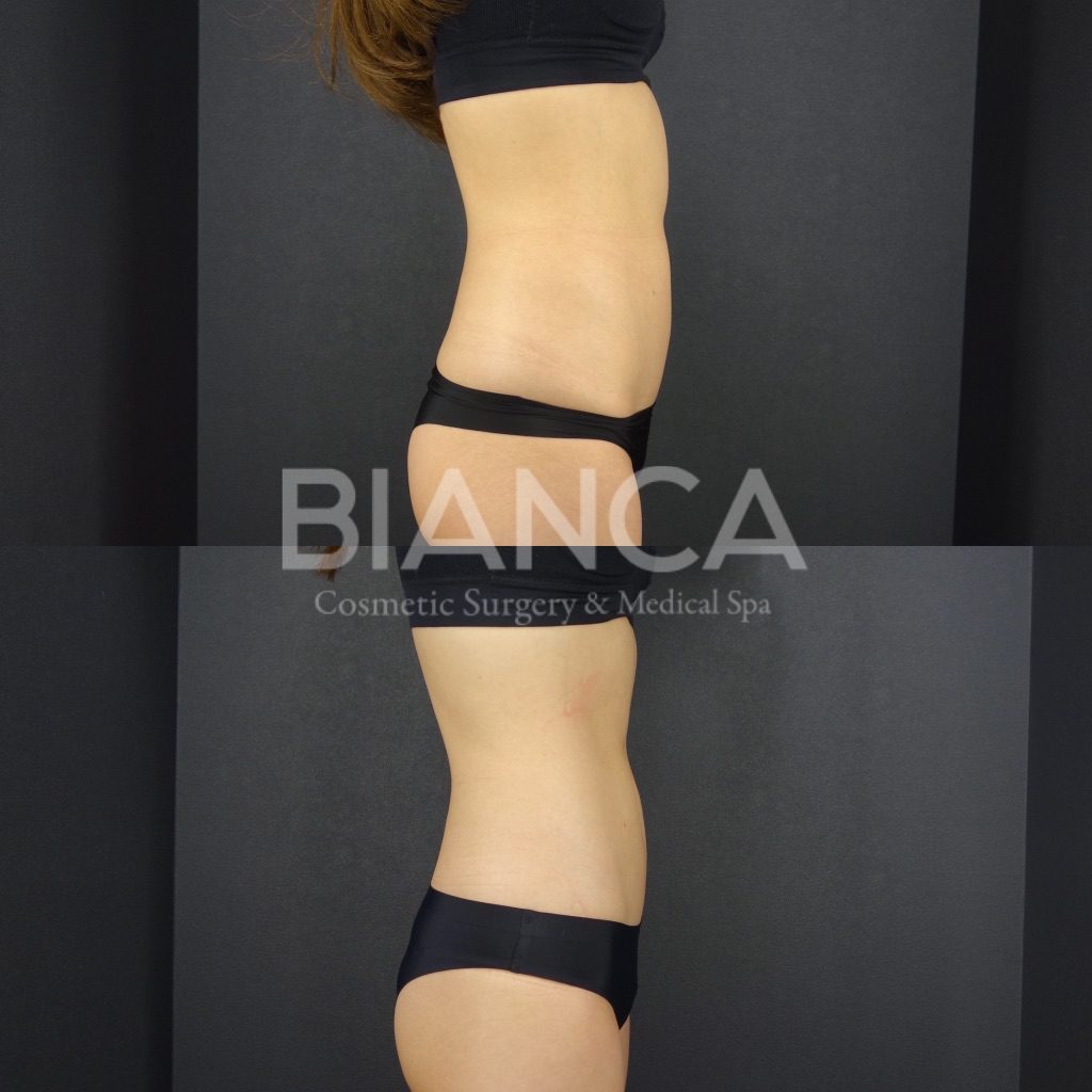 EMSCULPT®︎（エムスカルプト）によるメディカルボディメイク症例写真・ビフォーアフター