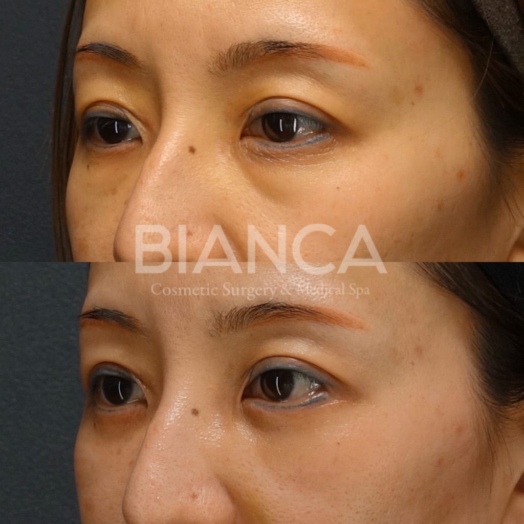 下瞼たるみ＋脂肪取り