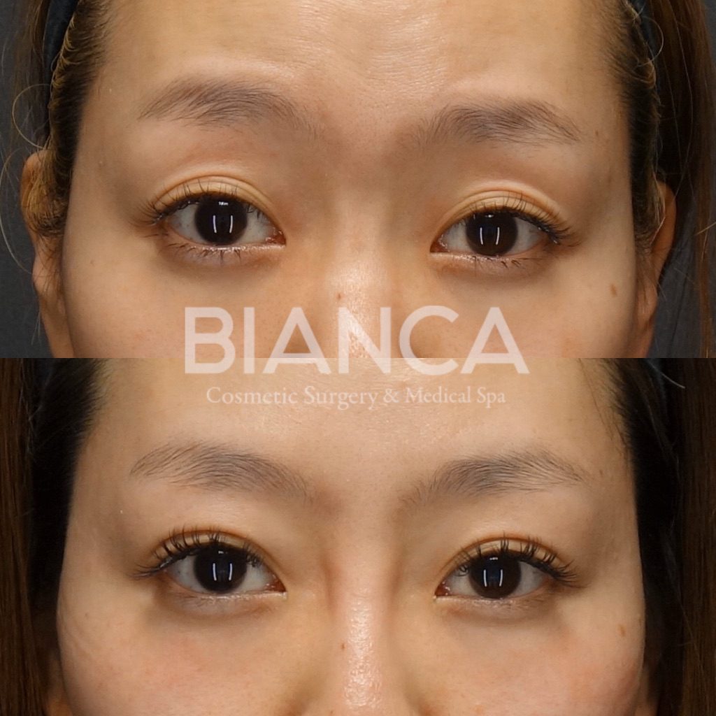 切らない眼瞼下垂（MT法） による二重整形の症例写真・ビフォーアフター