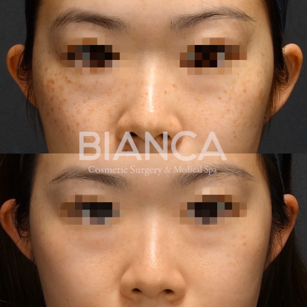 ピコシュアを用いたピコスポット、ピコトーニングでのシミ・そばかす治療の症例写真