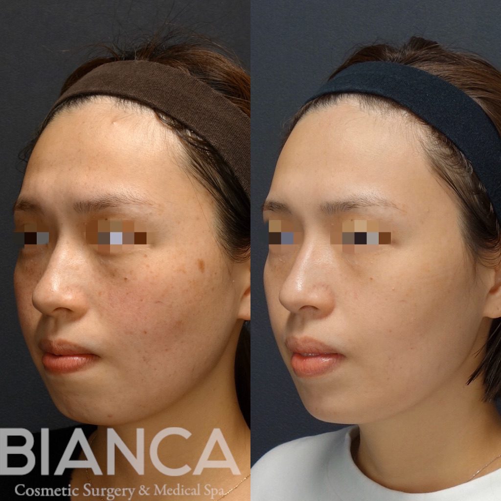 ピコシュアを用いたピコスポット、ピコトーニングでのシミ・そばかす治療の症例写真